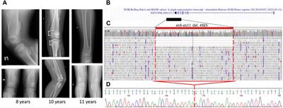 Cases report: Mosaic structural variants of the EXT1 gene in previously genetically unconfirmed multiple osteochondromas